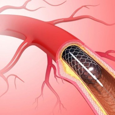 Quimioterapia Intra-arterial em Esteio -RS