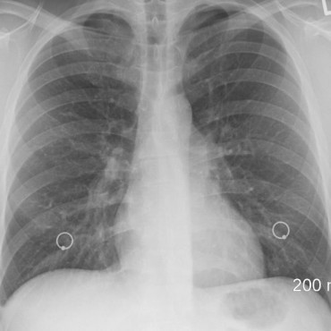 Biópsia pulmonar em Esteio -RS