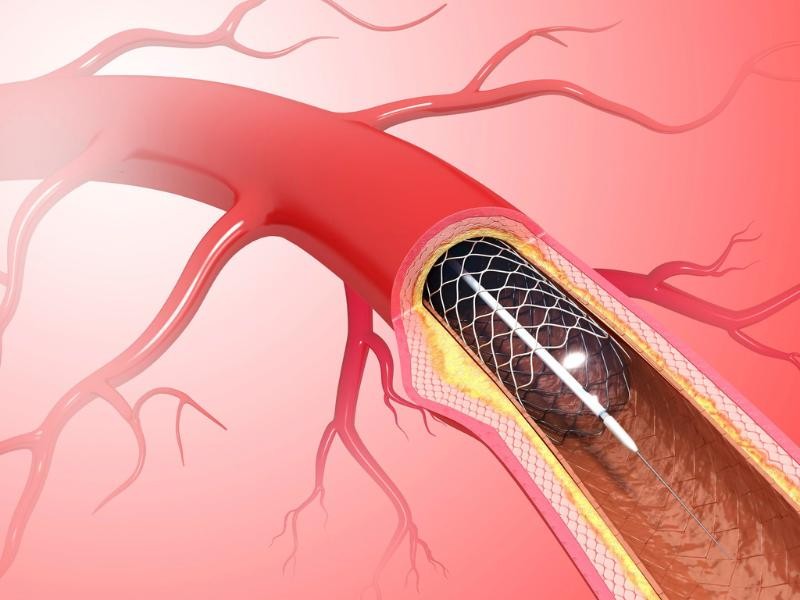 Quimioterapia Intra-arterial