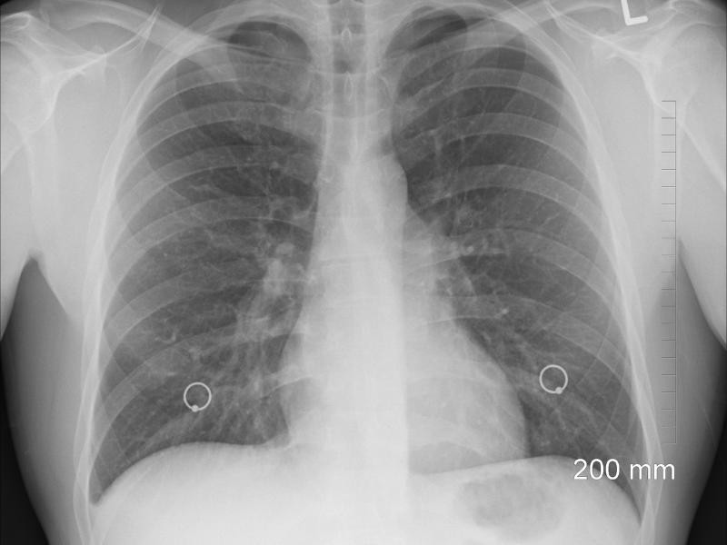 Biópsia pulmonar